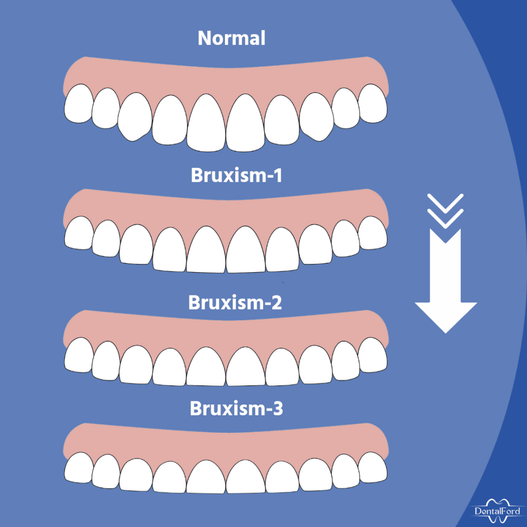 teeth flattening