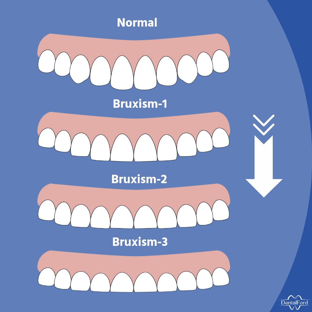 What is Bruxism (Teeth grinding)? Causes and Treatment