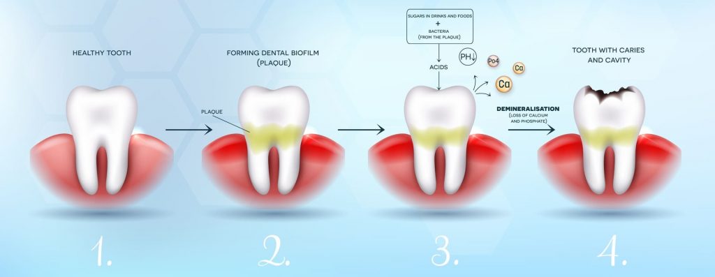 Dental plaque causes dental caries or cavities