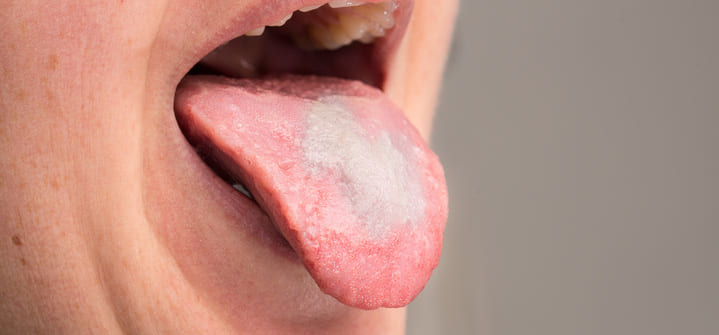 White-tongue-coating