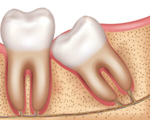 Wisdom tooth put pressure on adjacent tooth