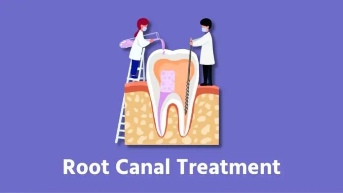 Root canal treatment (RCT)