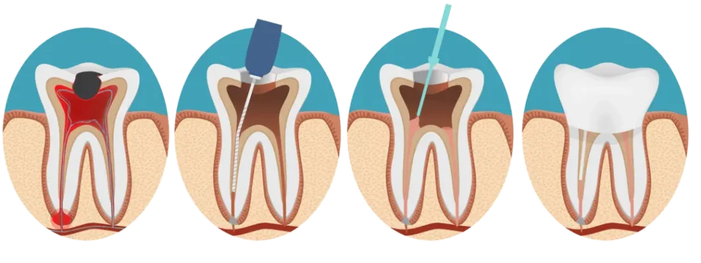 Root canal treatment steps