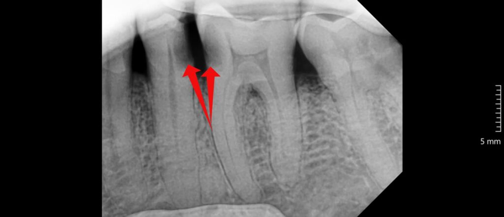 Proximal caries X-ray