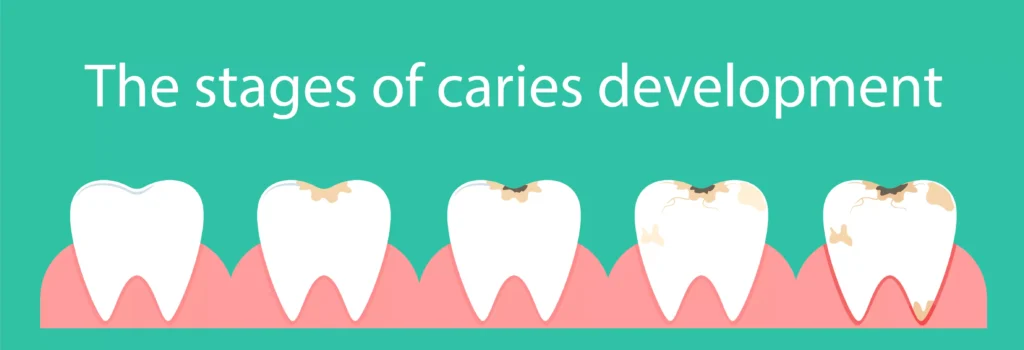 Stages of tooth decay