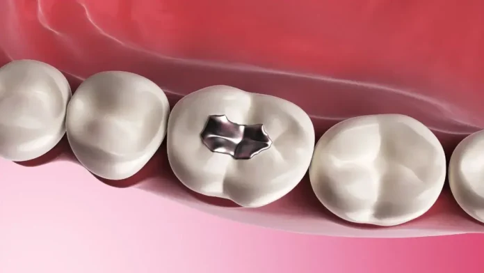 Dental fillings or tooth root