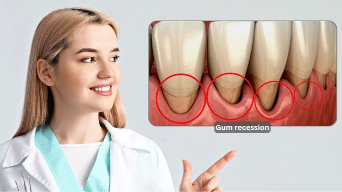 Gum recession or gingival recession