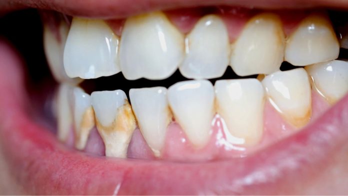 Calculus or tartar on teeth