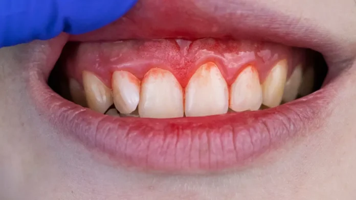 Bleeding Gums or Gingiva